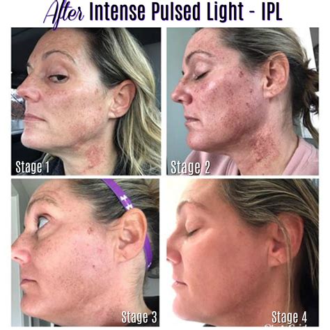 Skin Changes After Intense Pulsed Light – IPL – Charmed Medispa