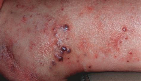 Topical 0.1% Alitretinoin Gel for Classic Kaposi Sarcoma | Dermatology ...