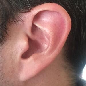 All about earlobes!: West End Facial Plastic Surgery: Facial Plastic Surgery