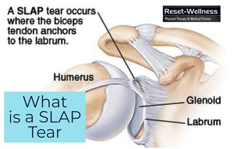 What is a SLAP tear? | Reset-Wellness Physical Therapy