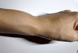 Swollen Wrist - Cause, Symptoms, Diagnosis, Treatment