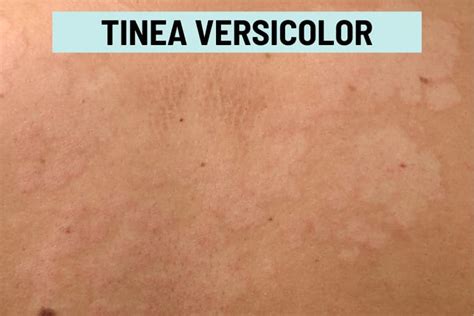 Tinea Versicolor: Healing Stages, Pictures, and Treatment