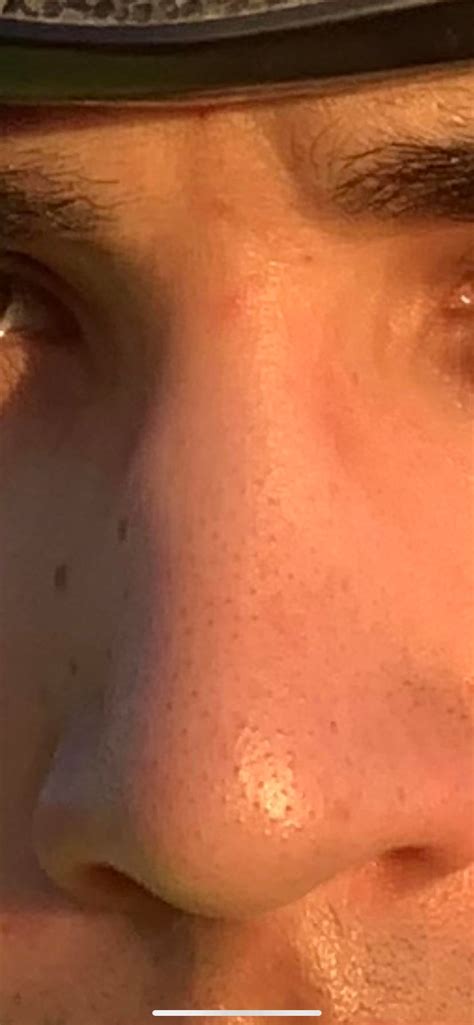 [Skin Concerns] Are those black dots on my nose normal? They’re so ...