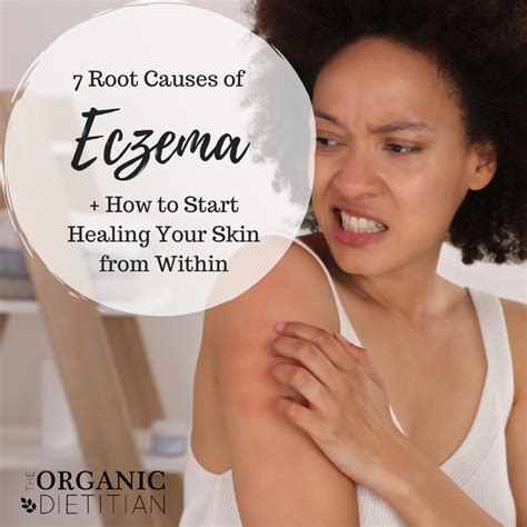 7 Root Causes of Eczema + How to Start Healing Your Skin from Within ...