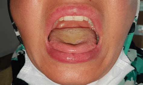 Resolution of the mucosal lesions following the treatment | Download Scientific Diagram