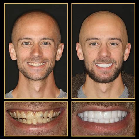 Smile Makeover | The Cosmetic Dentists of Austin, Texas