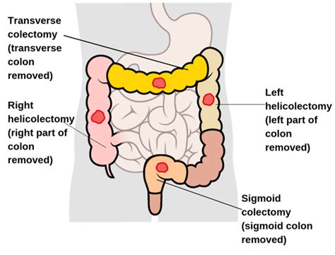 Types of surgery for colon and rectal cancer | Irish Cancer Society