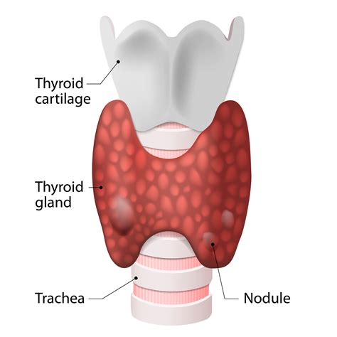 Symptoms Of Thyroid Nodule Youtube | My XXX Hot Girl