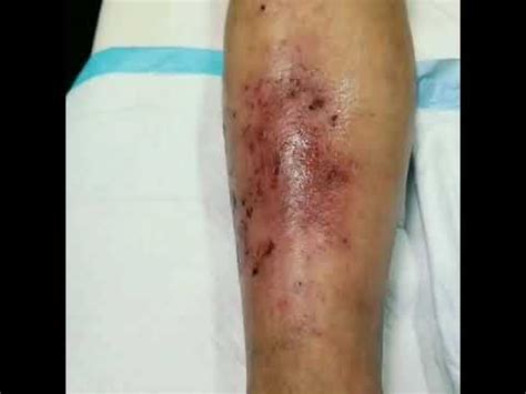 Using Platelets rich plasma for wound healing - YouTube