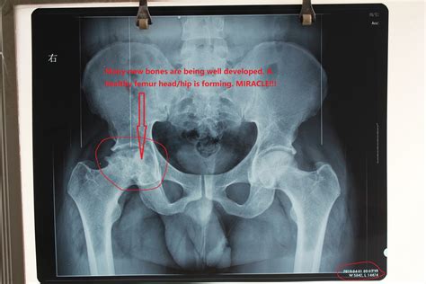 Hip Replacement Alternatives – Hip Replacement Option