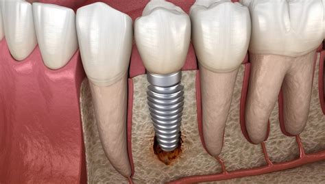 How To Treat Dental Implant Infection: Dental Treatment Procedure