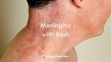 Meningitis With Rash: What is It and How to Treat - Medical Trends Now