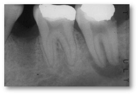 Tooth Abscess - Gentle Dental Centre