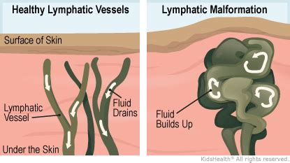 Lymphatic Malformations (for Parents) - Humana - Louisiana