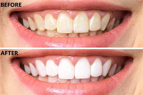 Laser Teeth Whitening | Swindon |Ambience Dental Practice