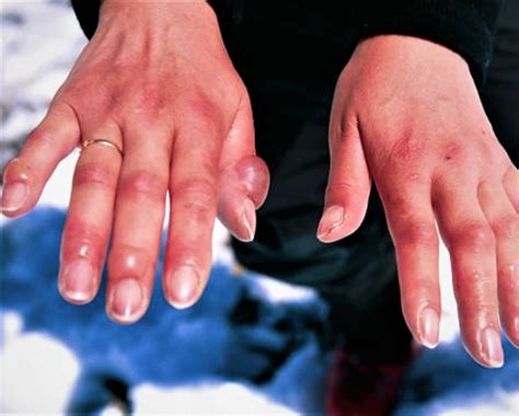 Frostbite - Causes, Prevention, Signs, Symptoms & Frostbite Treatment