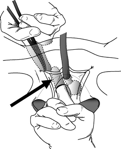 Pubovaginal Fascial Sling for the Treatment of all Types of Stress Urinary Incontinence ...