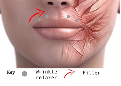 What Filler Is Best For Lip Lines - Health Future Quotes