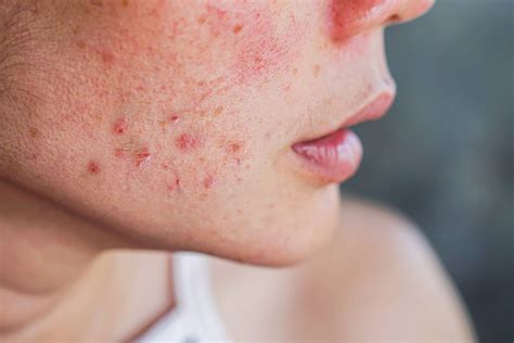 Menopause acne: causes and treatment