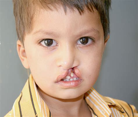 Cleft Lip Surgery After Care - Primary Cleft Lip & Nasal Reconstruction Gallery | St ... / Cleft ...