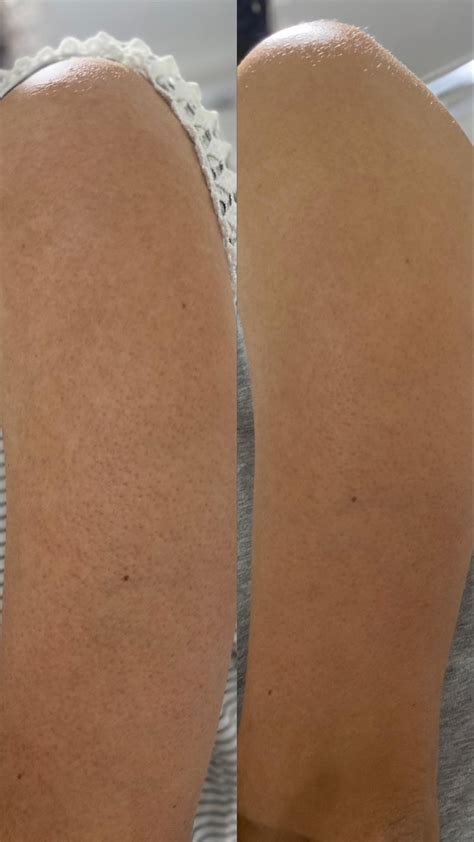 KP on arm, before and after : r/keratosis