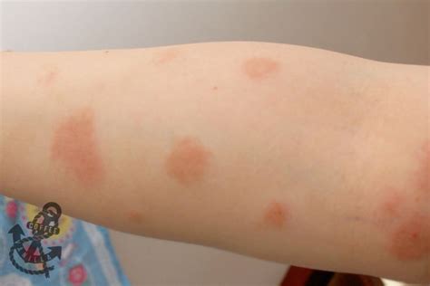 Autumn Allergy? Mould Spores Allergy? Dust Mite Allergy? What is it? » Coffee & Vanilla | Eczema ...