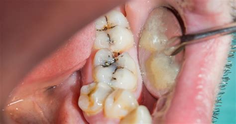 Redefining the Future of Health Services: Hyperdontia Causes Symptoms ...