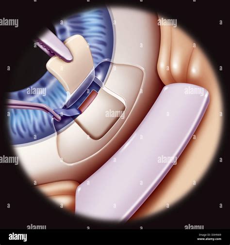 GLAUCOMA SURGERY, DRAWING Stock Photo - Alamy