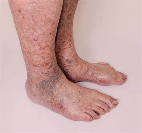 Varicose Leg Veins In Men - Treatment In Pittsburgh - Vein Center