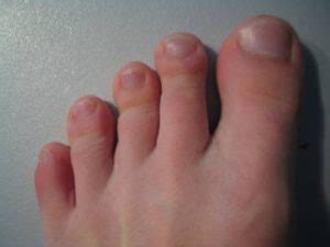 What Causes Big Toe on the Left Foot is Numb