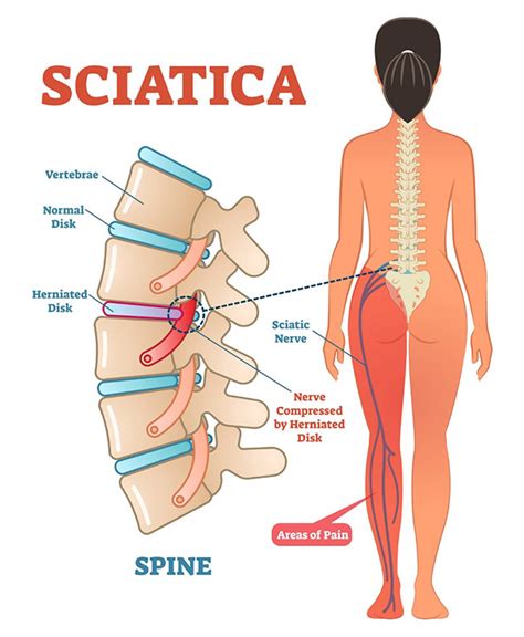 Sciatica – Causes, Symptoms & Treatment