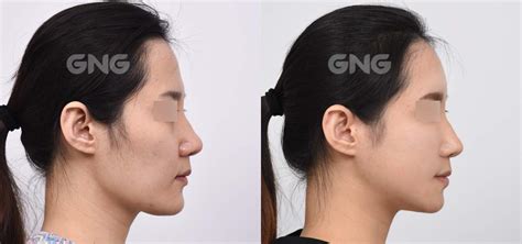 How forehead augmentation surgery can make you look more beautifulMedisetter