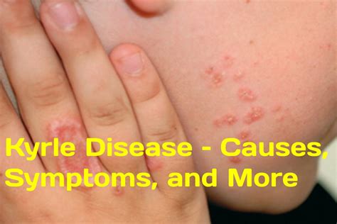 Kyrle Disease – Causes, Symptoms, and More