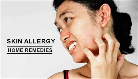 Top 10 Home Remedies to Get Rid of Skin Allergies