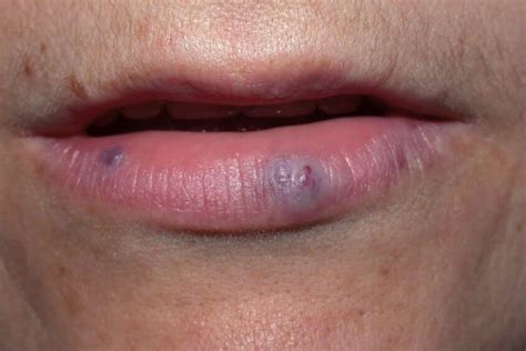 Purple Spot On The Lip: What Can Be The Cause?