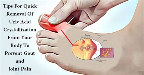 Arthritis in the bones in the feet is often caused by malfunction of the m… | Rheumatoid ...