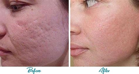 Patient 18616225 | Acne Scars Before & After Photos | Alinea Medical Spa Acne Scar & Laser Skin Care