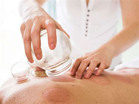 Everything you need to know about cupping, a traditional Chinese medical technique - ABC News