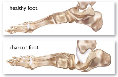 Complications with Charcot Foot | International Orthotic Labs Inc.