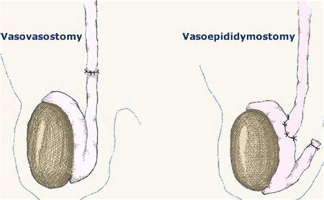 Multiple Attempts at Vasectomy Reversal - Top Vasectomy Reversal Doctor NYC