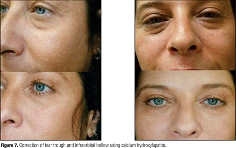 Avoiding malar edema during midface/cheek augmentation with dermal ...