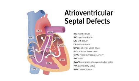 Atrioventricular Septal Defect (AVSD) | Concise Medical Knowledge