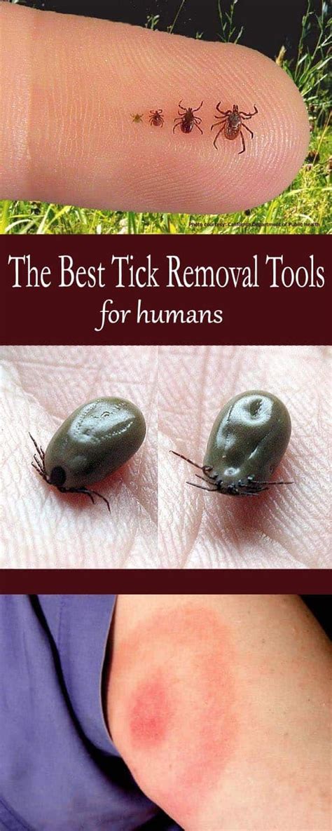 How To Remove A Tick Head If It Breaks Off - HOWOTREMVO