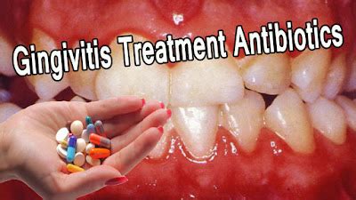 Gingivitis Treatment Antibiotics