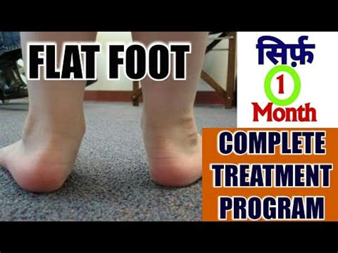 FLAT FEET Treatment-Complete Exercise PROGRAM To Correct Flat Feet OR FALLEN ARCHES - YouTube