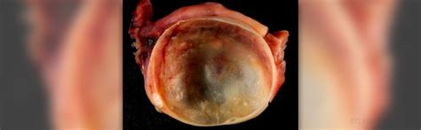 Ovarian cysts complications | General center | SteadyHealth.com