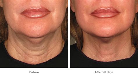 Ultherapy Neck Treatments | Ultherapy for Neck NYC - Smooth Synergy Medical Spa & Laser Center