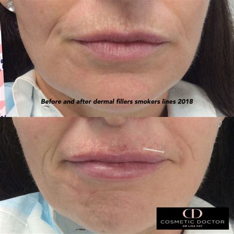 before-after-lip-fillers-smokers-lines - Cosmetic Doctor Dublin