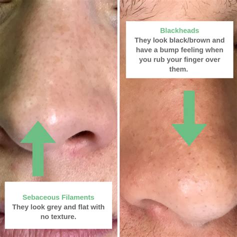 Sebaceous Filaments VS Blackheads : What is the difference – Skin+