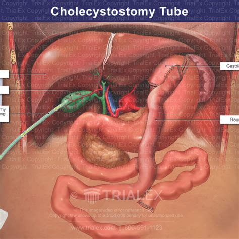 Cholecystectomy Tube - TrialQuest Inc.